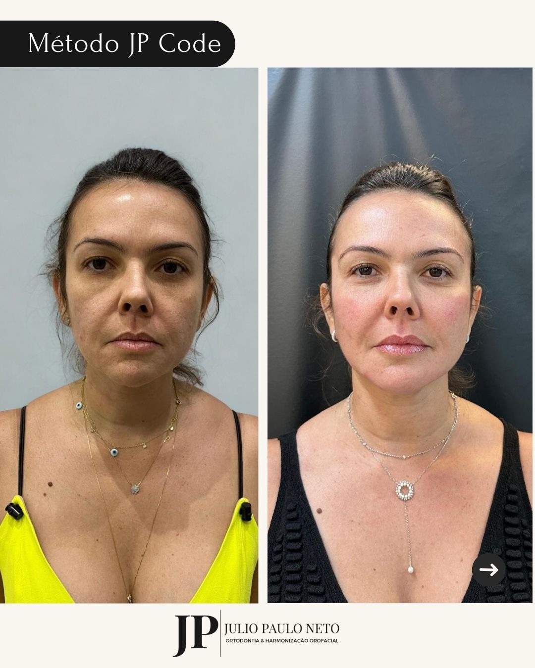 Resultado de harmonização facial, antes e depois, perfil lateral