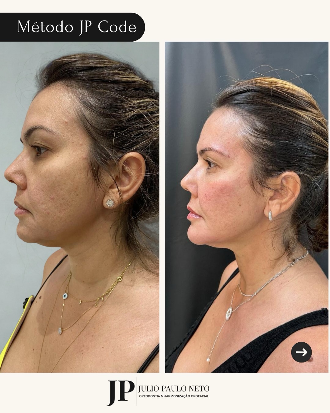 Resultado de harmonização facial, antes e depois, perfil lateral