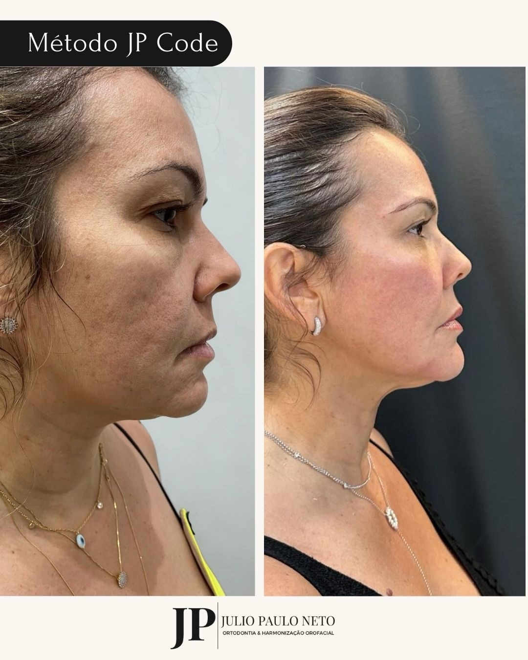 Resultado de harmonização facial, antes e depois, frontal